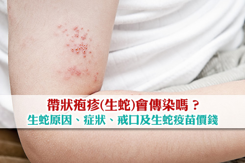 生蛇會傳染嗎 拆解生蛇原因 症狀及生蛇疫苗價錢 Esdlife健康網購