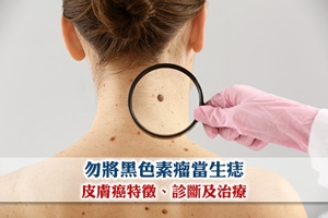 News: 皮膚癌 | 勿將黑色素瘤當生痣 皮膚癌特徵、診斷及治療