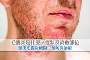 News: 毛囊炎是什麼？症狀| 高危部位| 頭皮毛囊炎成因、預防與治療