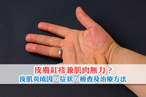 News: 皮膚紅疹兼肌肉無力？一文了解皮肌炎成因、症狀、檢查及治療方法